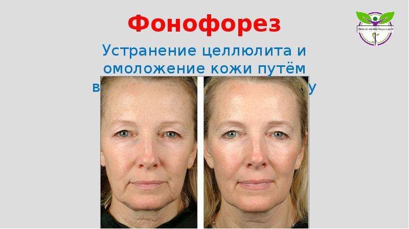 Фонофорез: показания и противопоказания, ультразвуковой фонофорез