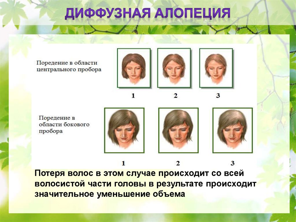 Диффузная алопеция у женщин и мужчин – причины и лечение телогеновой алопеции