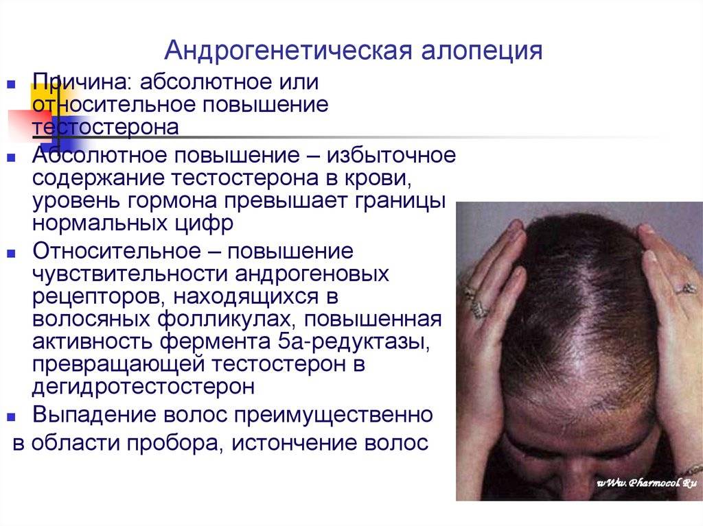 Основные виды алопеции (выпадения волос) и причины алопеции