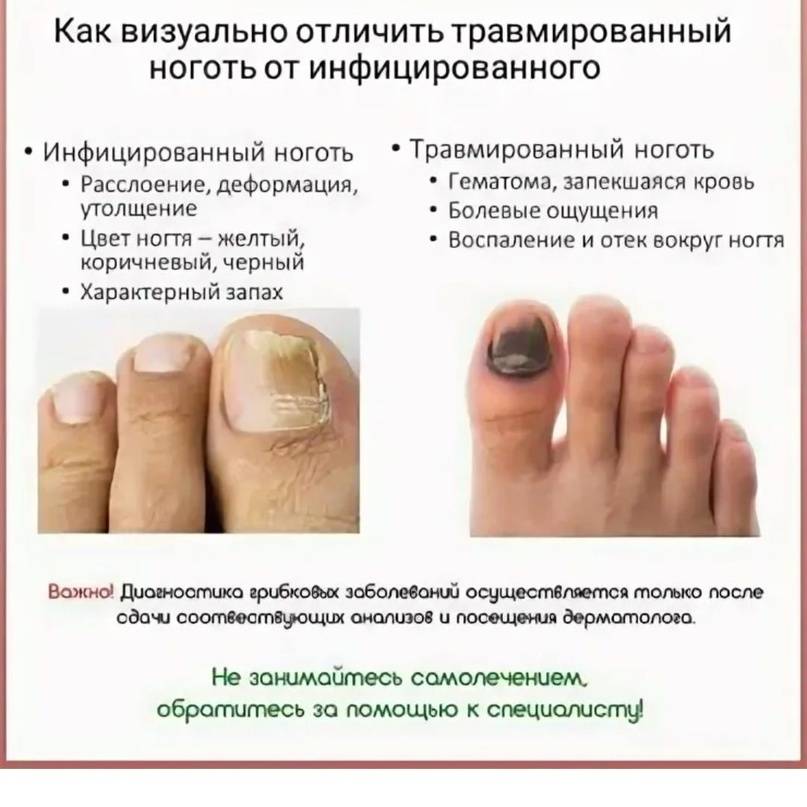 Как размягчить ногти на ногах в домашних условиях?