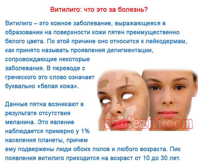Можно ли вылечить витилиго на лице: правда и мифы