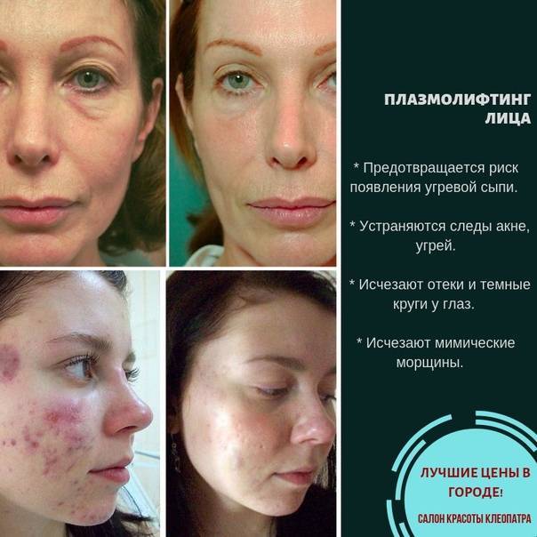 Плазмотерапия: что нужно знать?-mesoproff