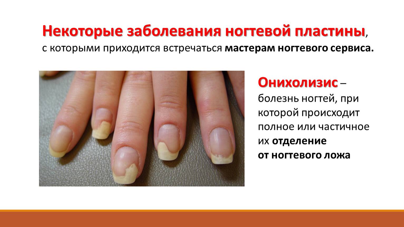 Грибок ногтей на руках: фото, начальная стадия и чем лечить