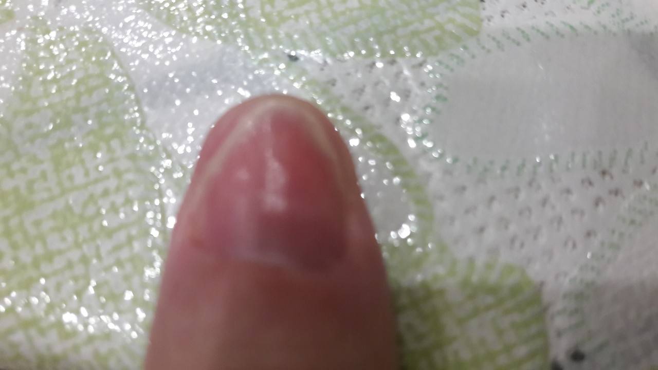 Дистрофия ногтевой пластины. симптомы, диагностика, лечение.
