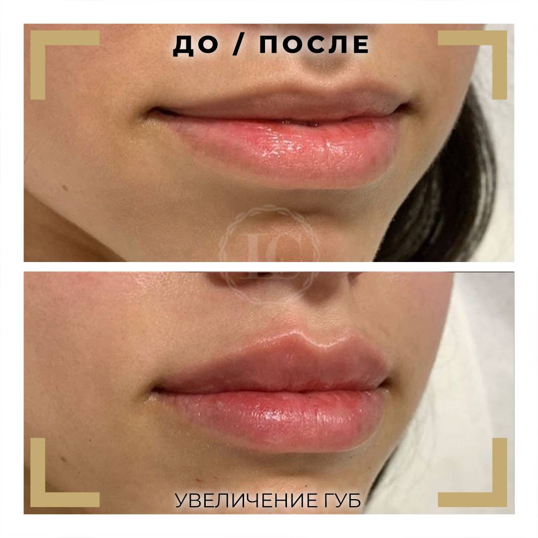 Массаж губ, техники для увеличения объема и красоты уст