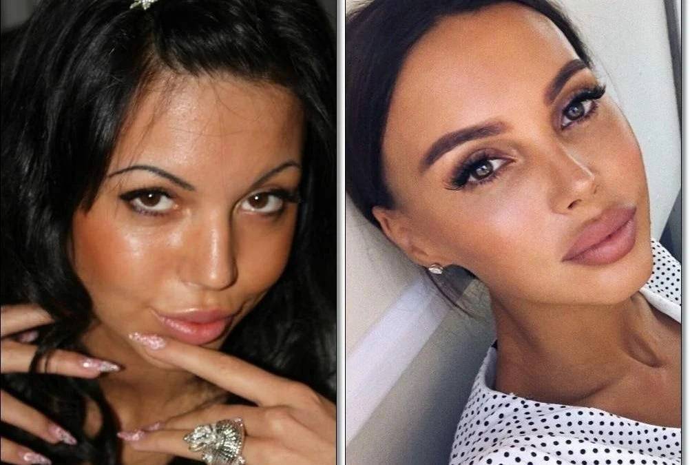 Оксана самойлова до и после пластики