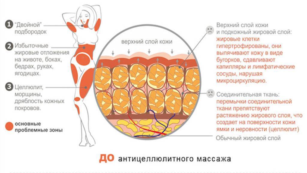 Почему не проходит целлюлит