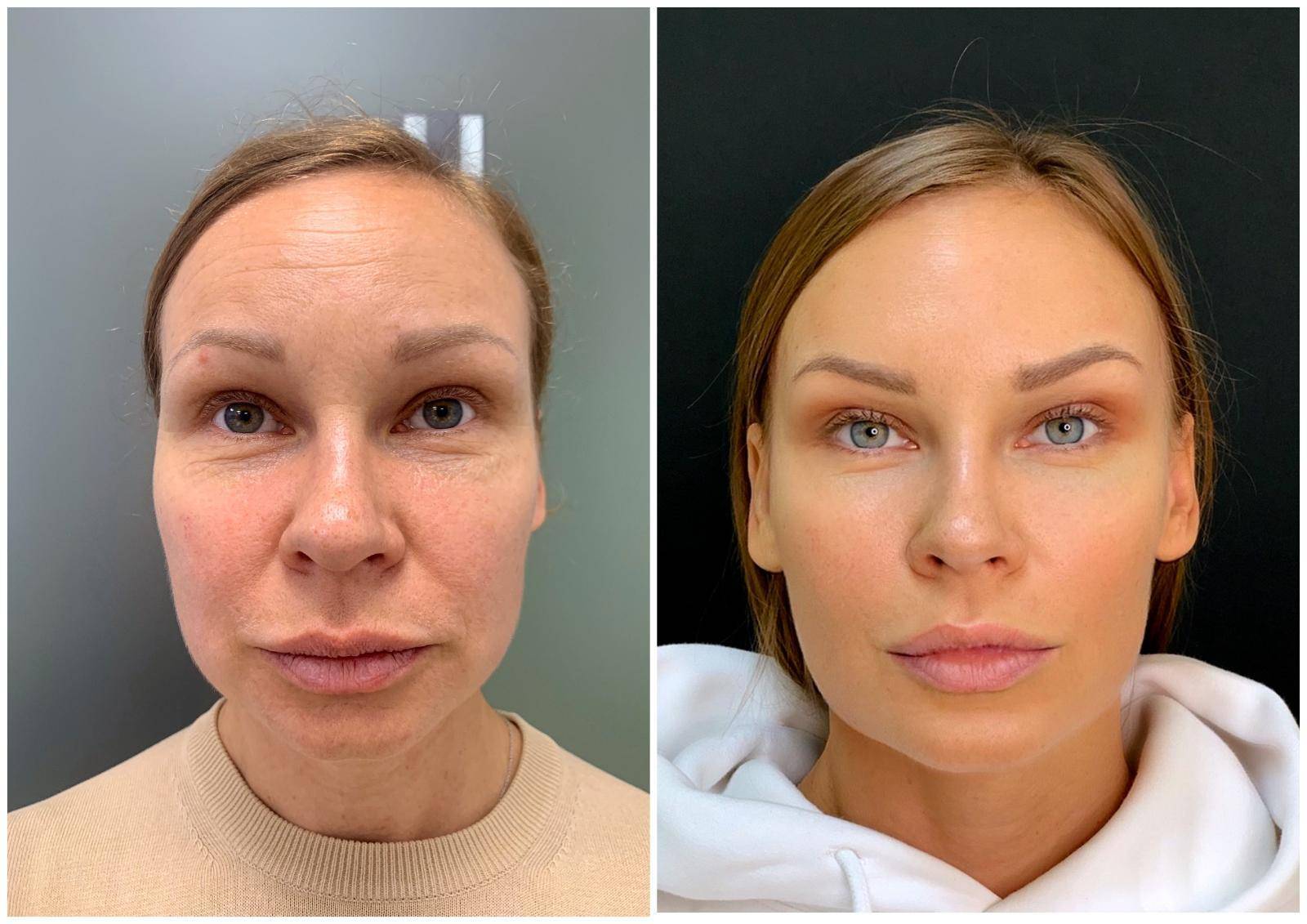 Нитевой лифтинг: плюсы и минусы процедуры | expert clinics
