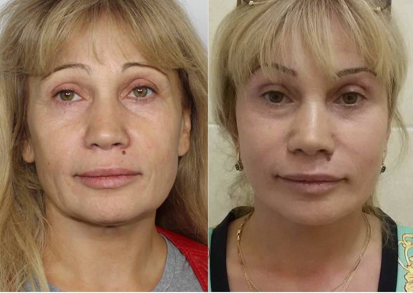Круговая подтяжка лица