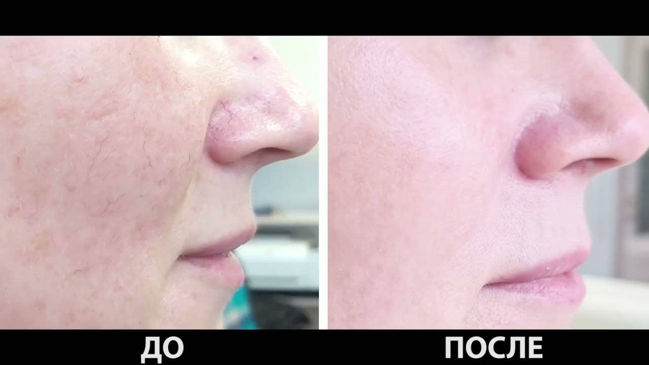 Купероз на лице: причины и лечение, как бороться и избавиться от купероза