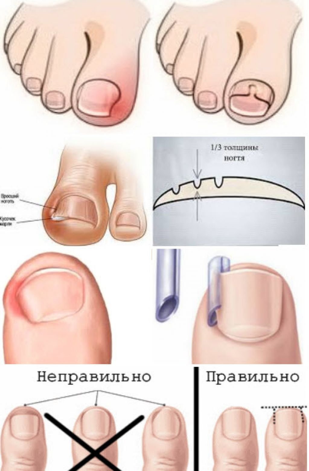 Как снять боль от врастающего ногтя - wikihow