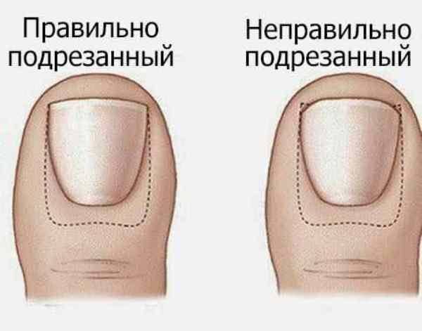 Как правильно подстричь вросший ноготь на большом пальце