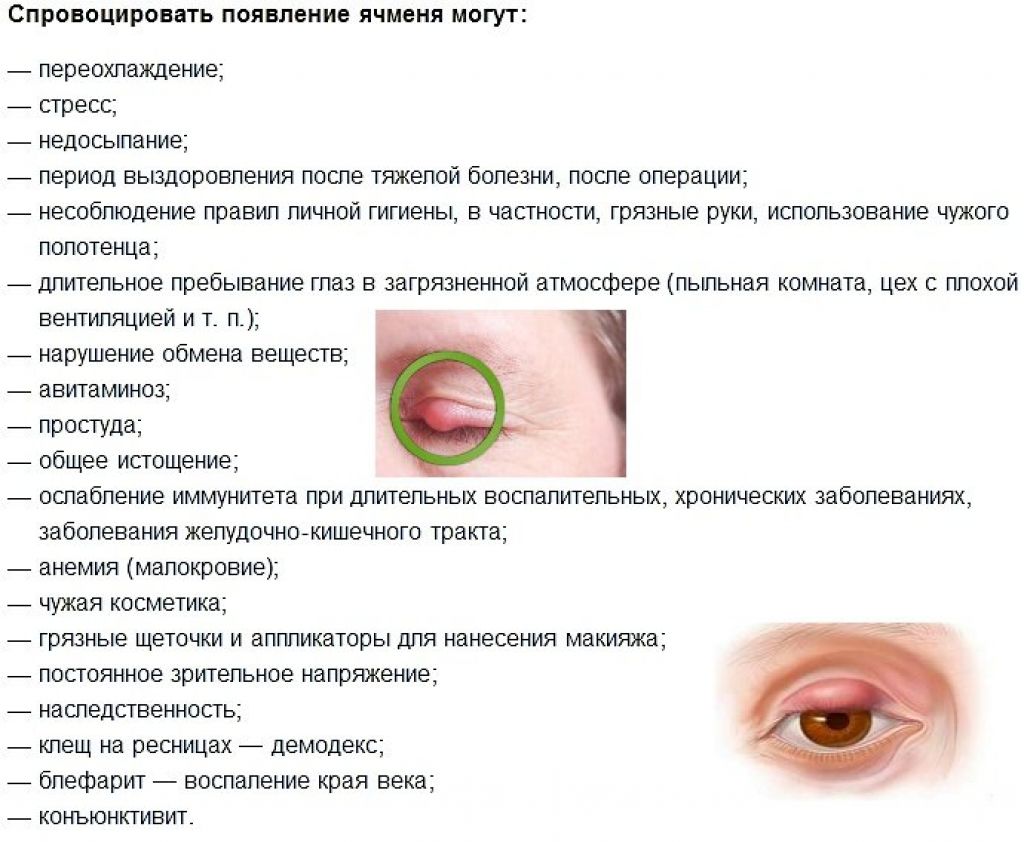 Ячмень на глазу: причины, виды патологии, лечение