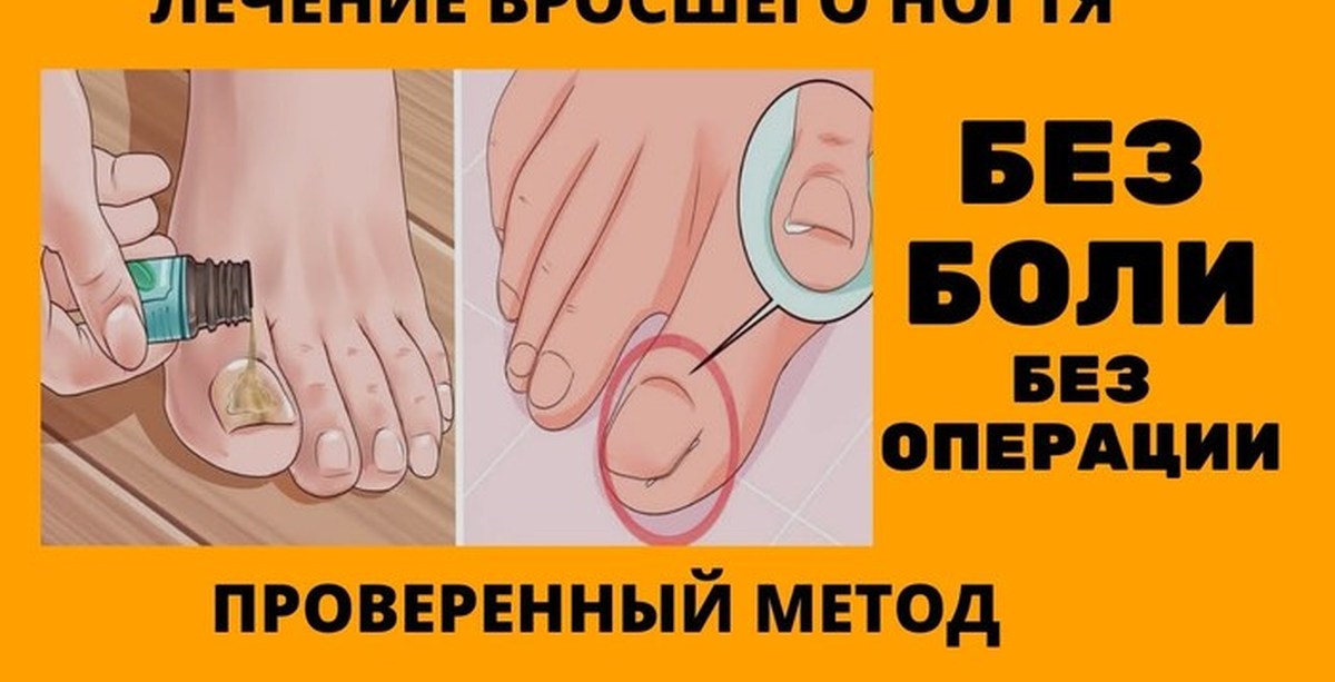 Помощь при вросшем ногте