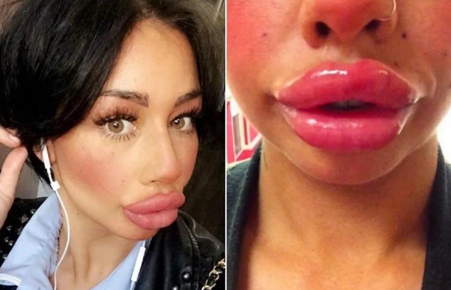 Силиконовые губы- как не стать обладательницей «trash duck face»