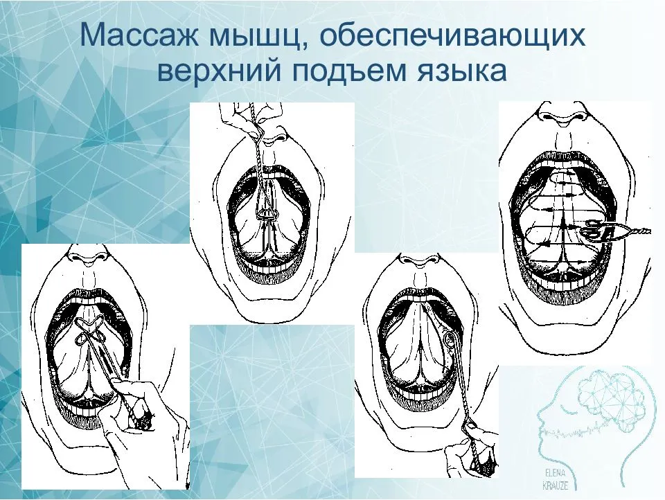 Логопедический массаж при дизартрии