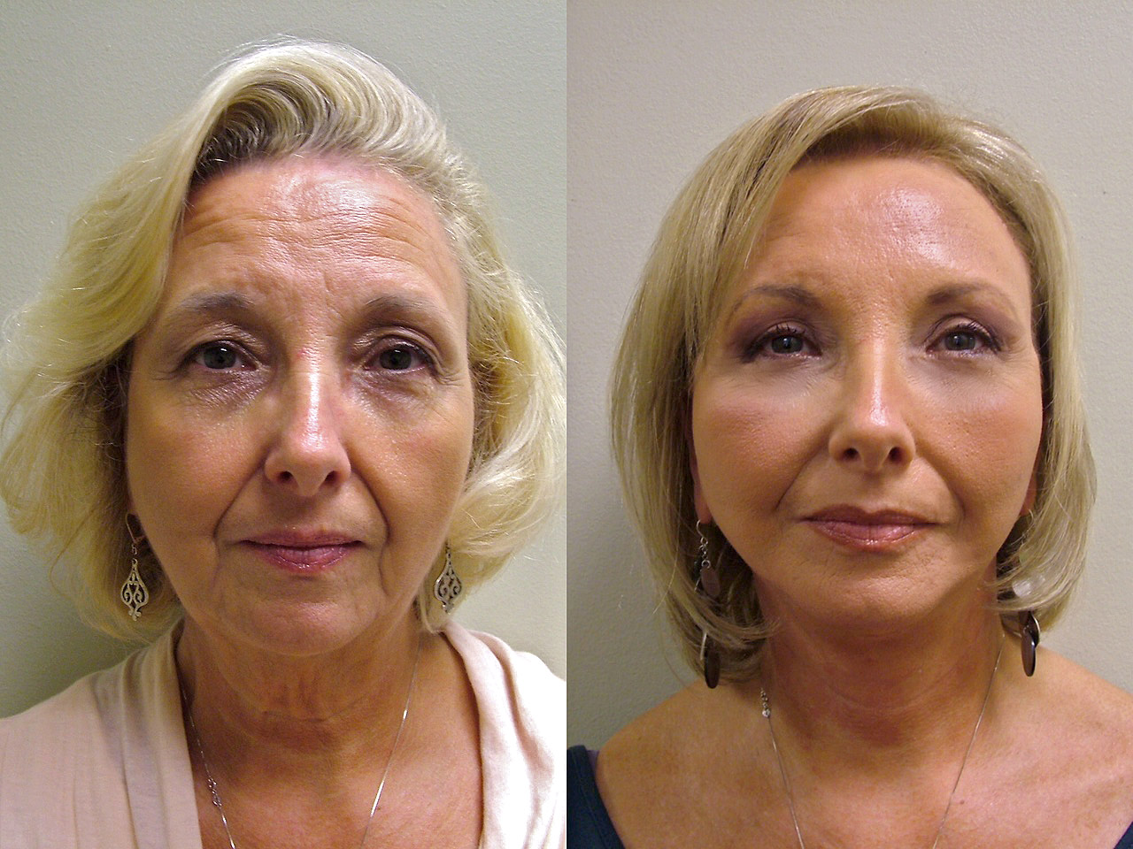 Sculptra — техника введения филлера и побочные действия