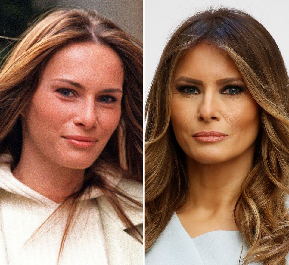 Мелания трамп до и после пластических операций, фото и видео