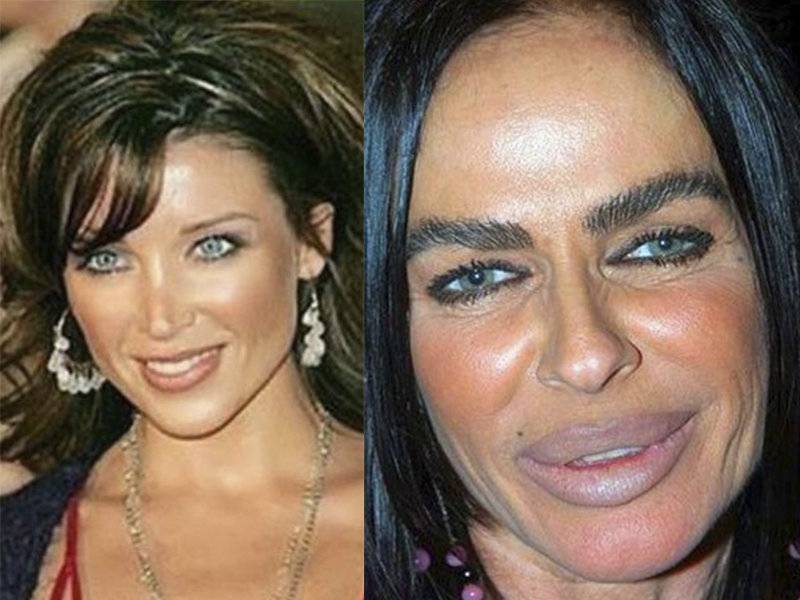 Жертвы пластической хирургии: коллагеновая микаела | за кадром