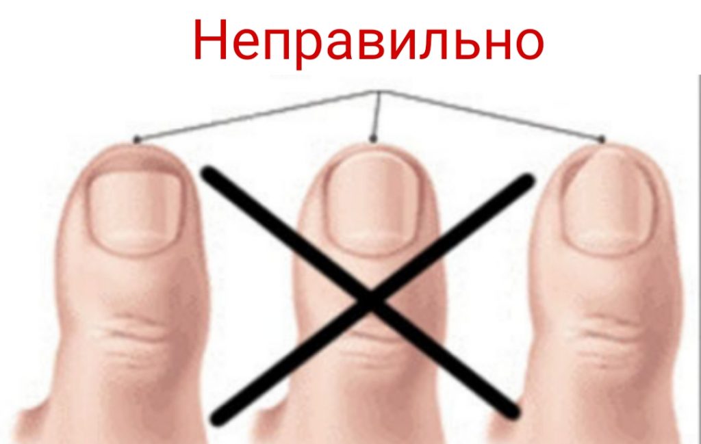 Как правильно подстричь вросший ноготь на большом пальце