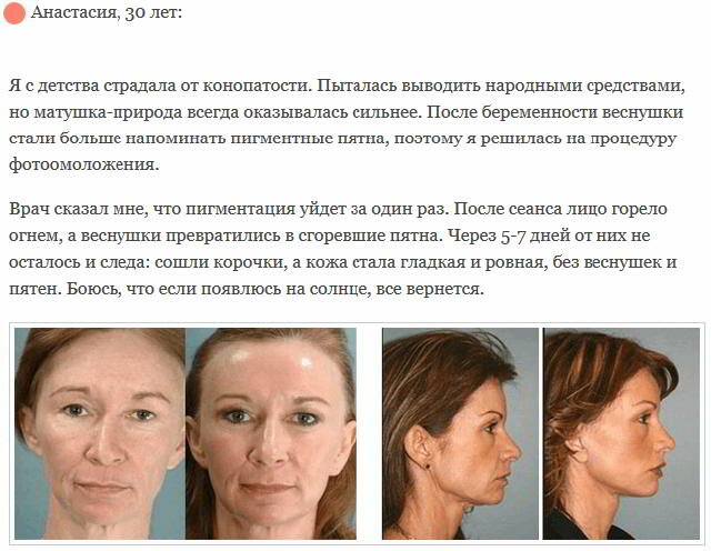 Фотоомоложение - методики и показания к фотоомоложению