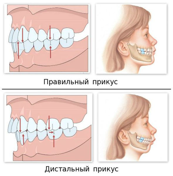 Последствия неправильного прикуса: влияние на здоровье и красоту лица