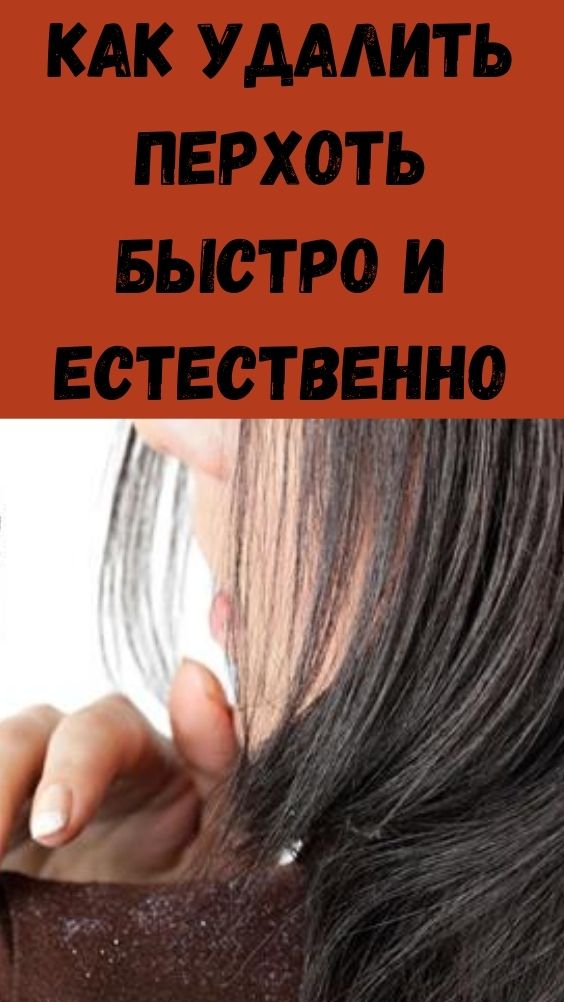 Перхоть на голове: как избавиться и что делать