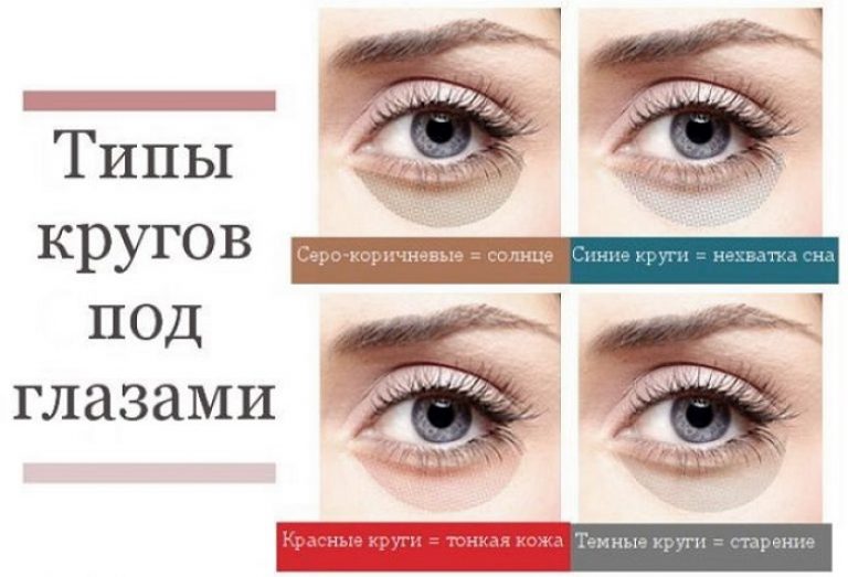 Как убрать синяки под глазами в домашних условиях быстро и эффективно: обзор средств от темных кругов и отзывы