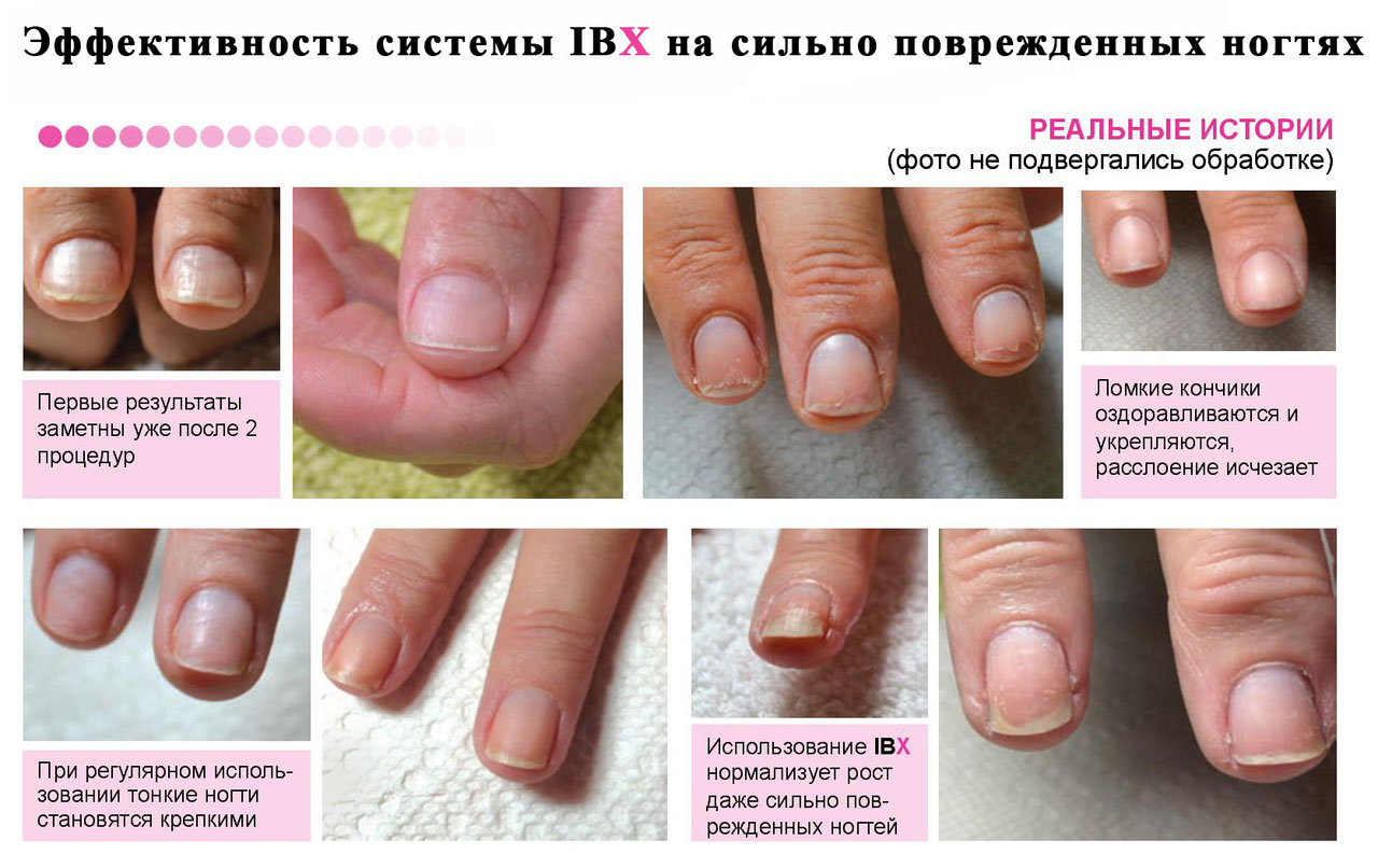Как восстановить ногти после шеллака и гель-лака: лечение, укрепление, профилактика в домашних условиях
