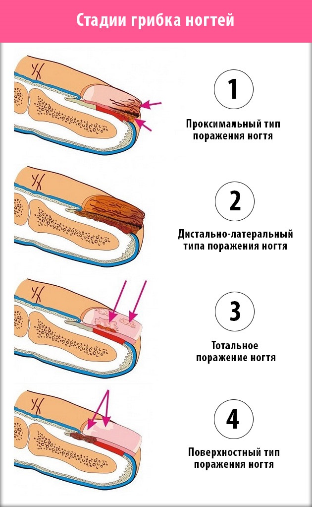 Отслоение ногтя — меры профилактики и лечение