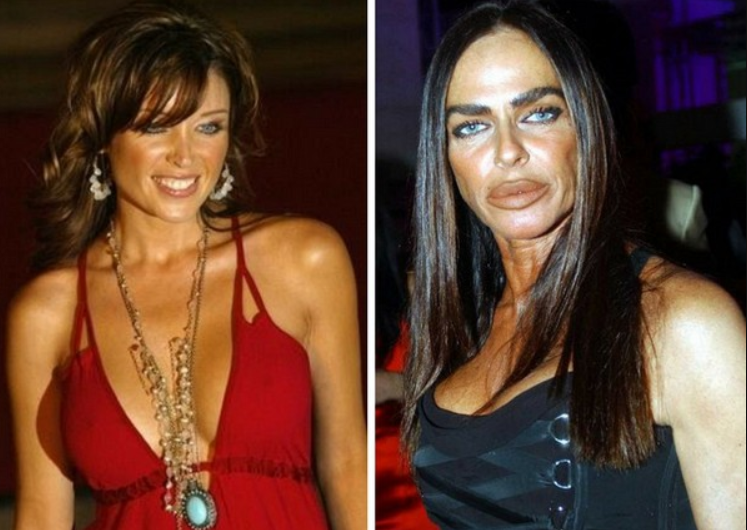 Ужасные пластические операции до и после. шокирующие жертвы пластической хирургии