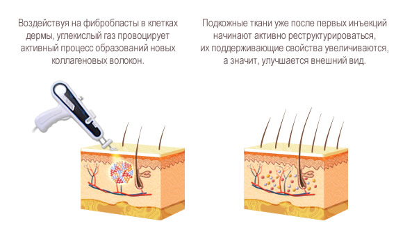 Неинвазивная карбокситерапия