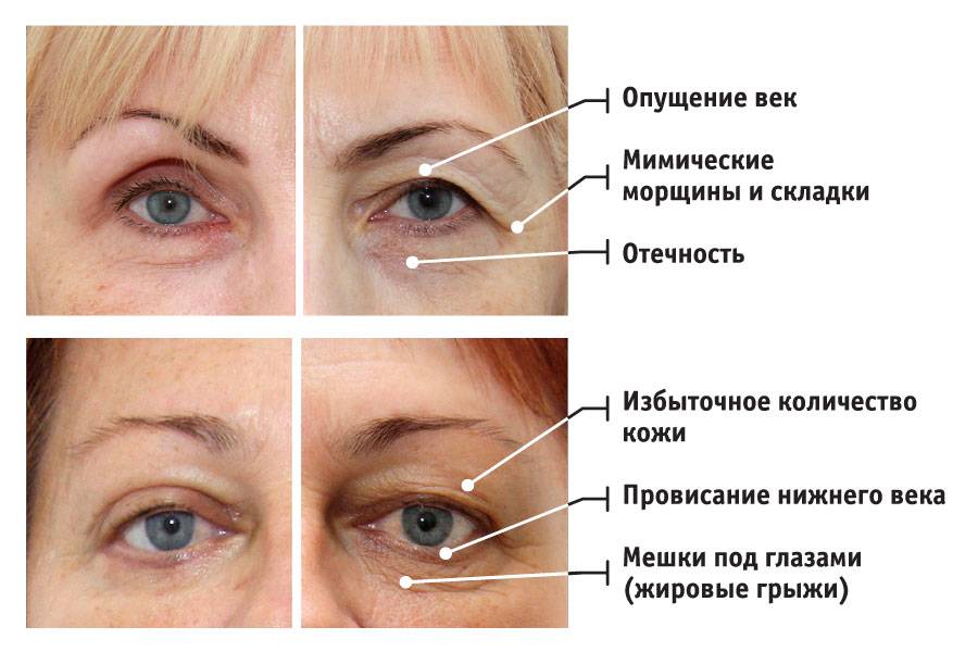Отёк от удара под глазом: что делать, как убрать?