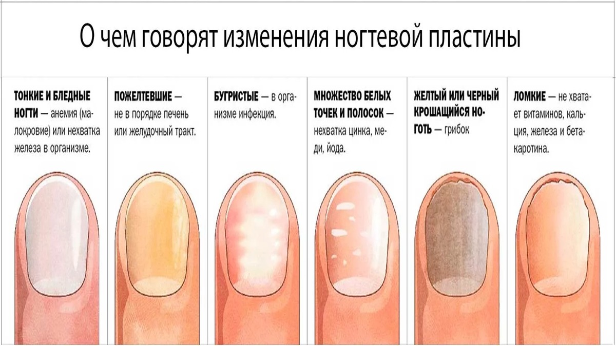 От чего истончаются ногти: распространенные причины
