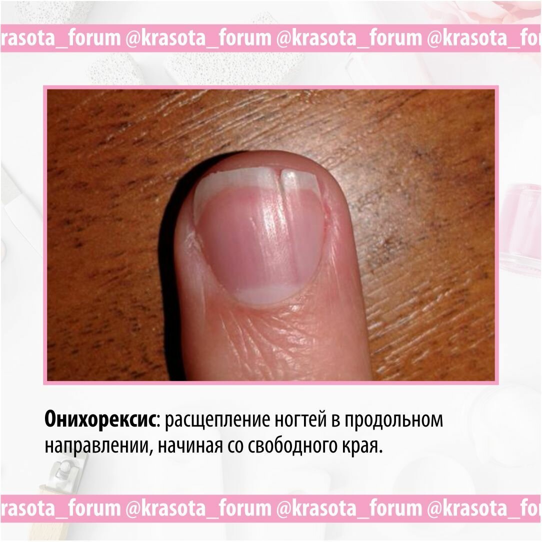 Полоски на ногтях