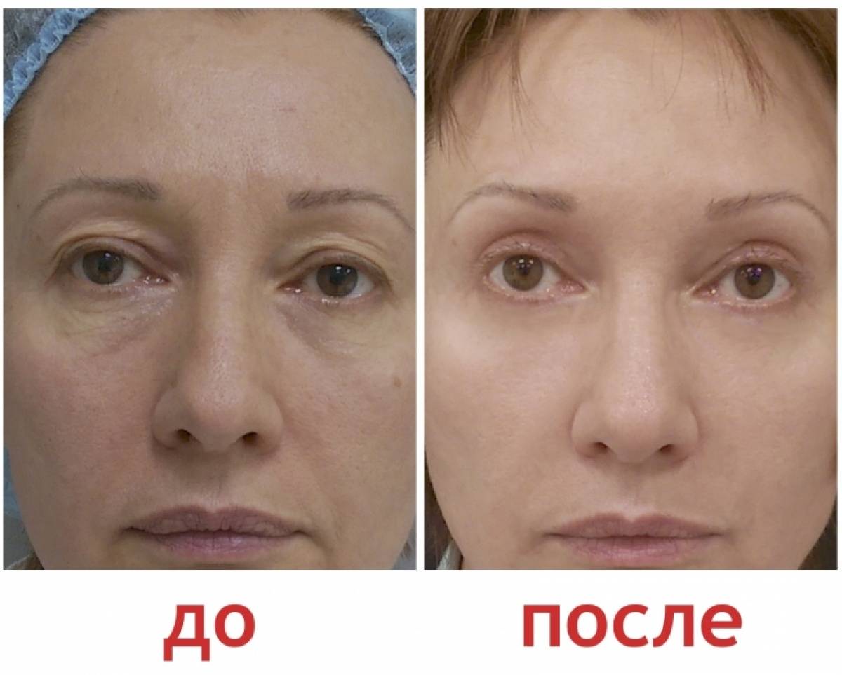Блефаропластика верхних век — оправдан ли риск