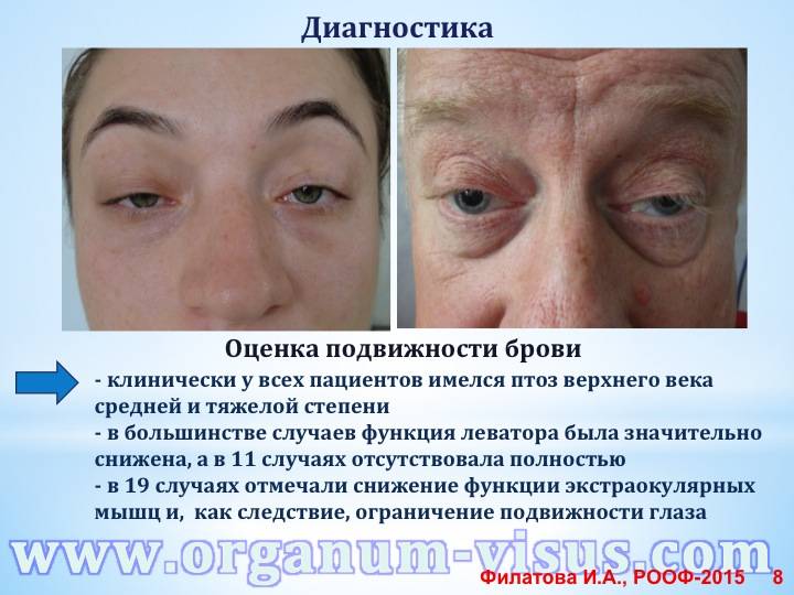 Птоз верхнего века - фото, причины, лечение, последствия