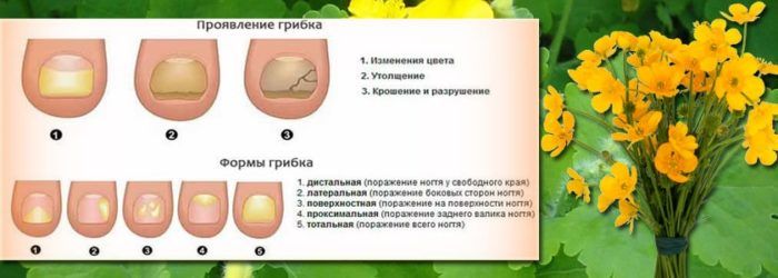 Лучшее масло от грибка ногтей: чайного дерева, монарды или лимона?