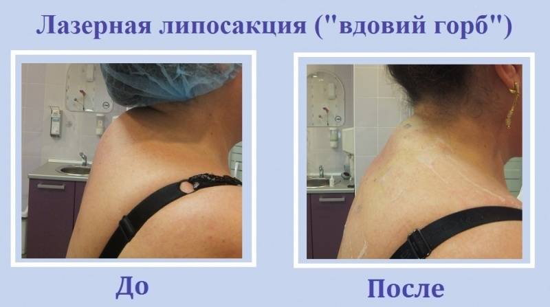 Липолиз – виды: лазерный, инъекционный, ультразвуковой