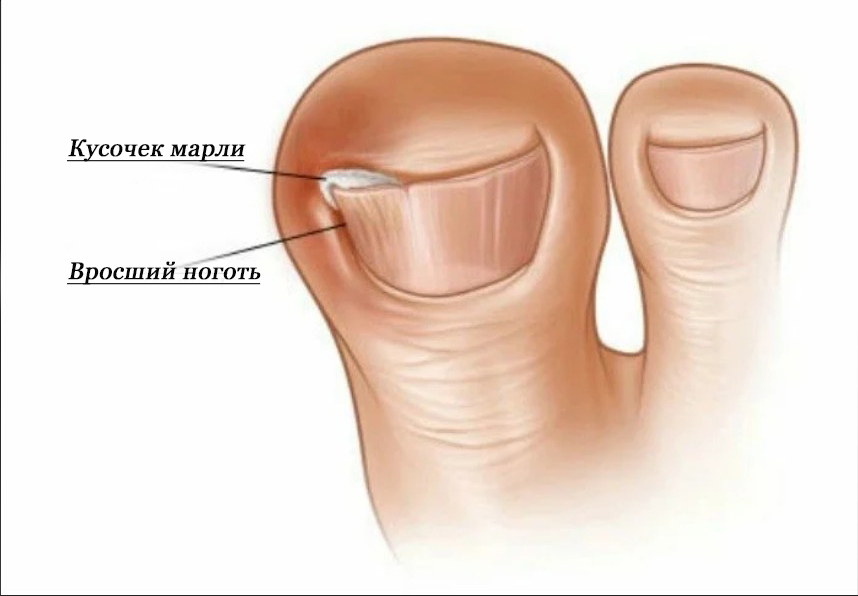 Как лечить вросший ноготь на ноге - медицинский портал doctor-365.net: симптомы и рекомендации по лечению различных заболеваний