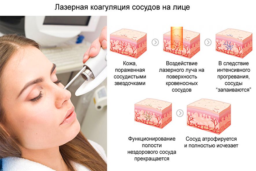Как убрать сосудистые звездочки на лице ✔️ блог клиники лица