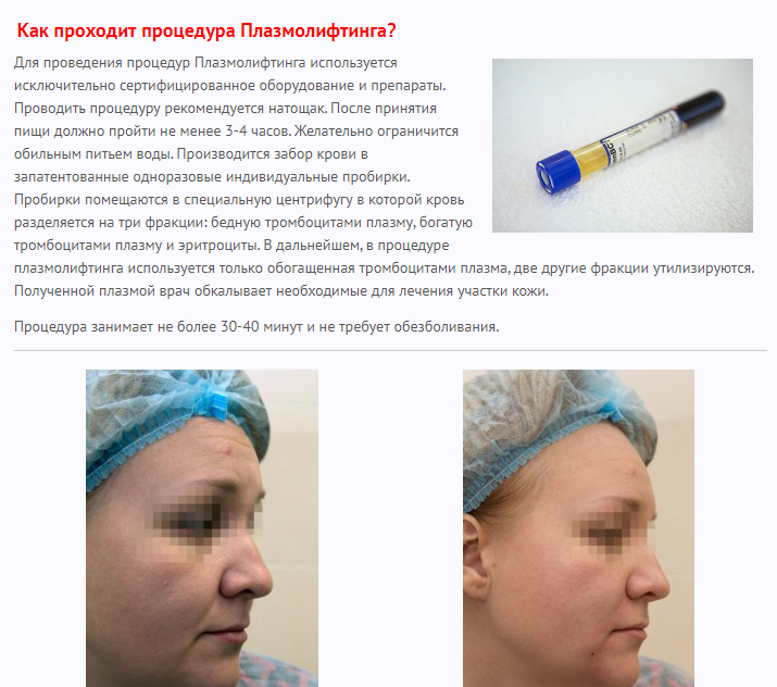 Протоколы плазмолифтинга: суть, правила проведения процедуры, рекомендации