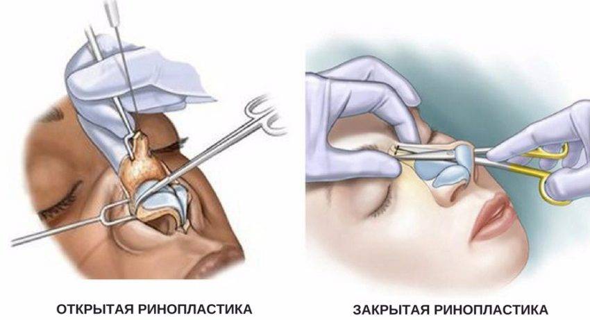 Безоперационная пластика носа: как это происходит