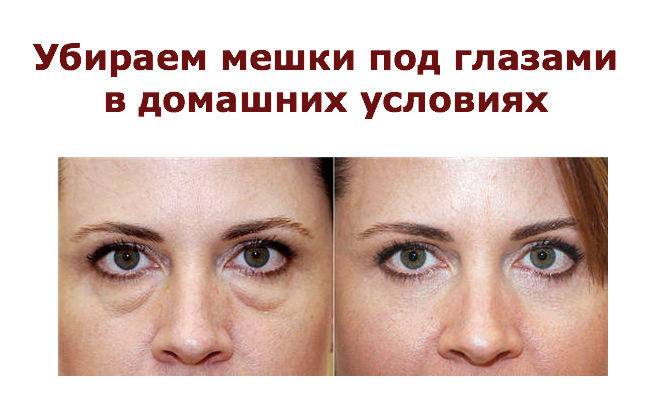 Молодой взгляд: как убрать морщины под глазами?
