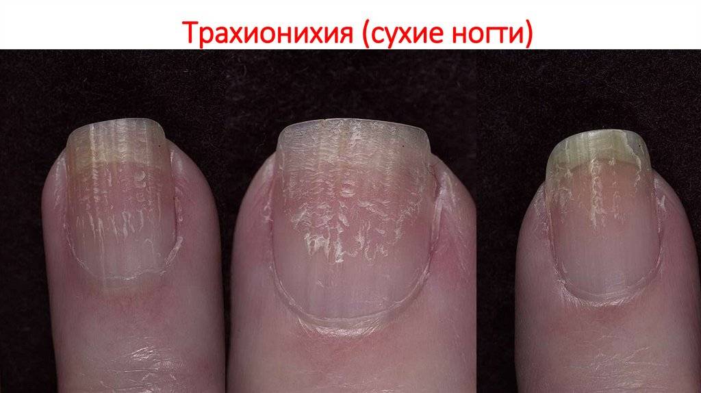 Болезни ногтей: причины, симптомы и лечение - «ваш доктор» - ваш медицинский журнал