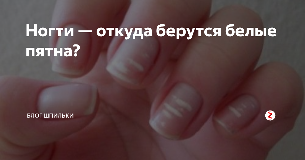 Почему на ногтях рук и ног появляются белые пятна. лейконихия. что означает, причины и лечение.