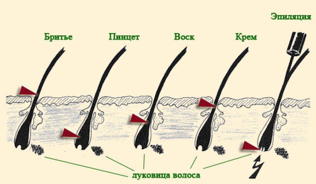 Эпиляция или депиляция в чем разница