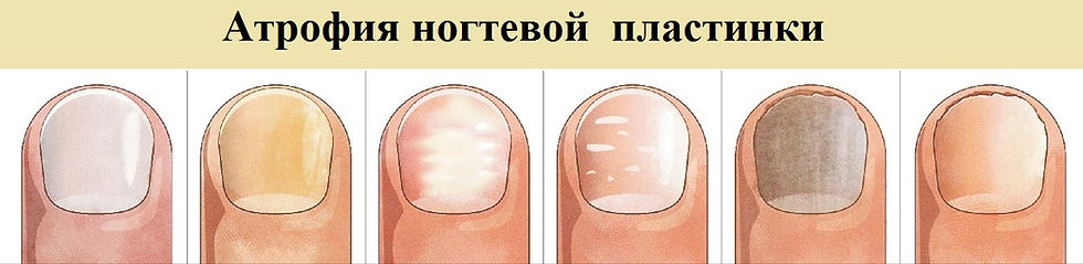 Причины появления продольных и поперечных полос и точек на ногтях, способы лечения и профилактика