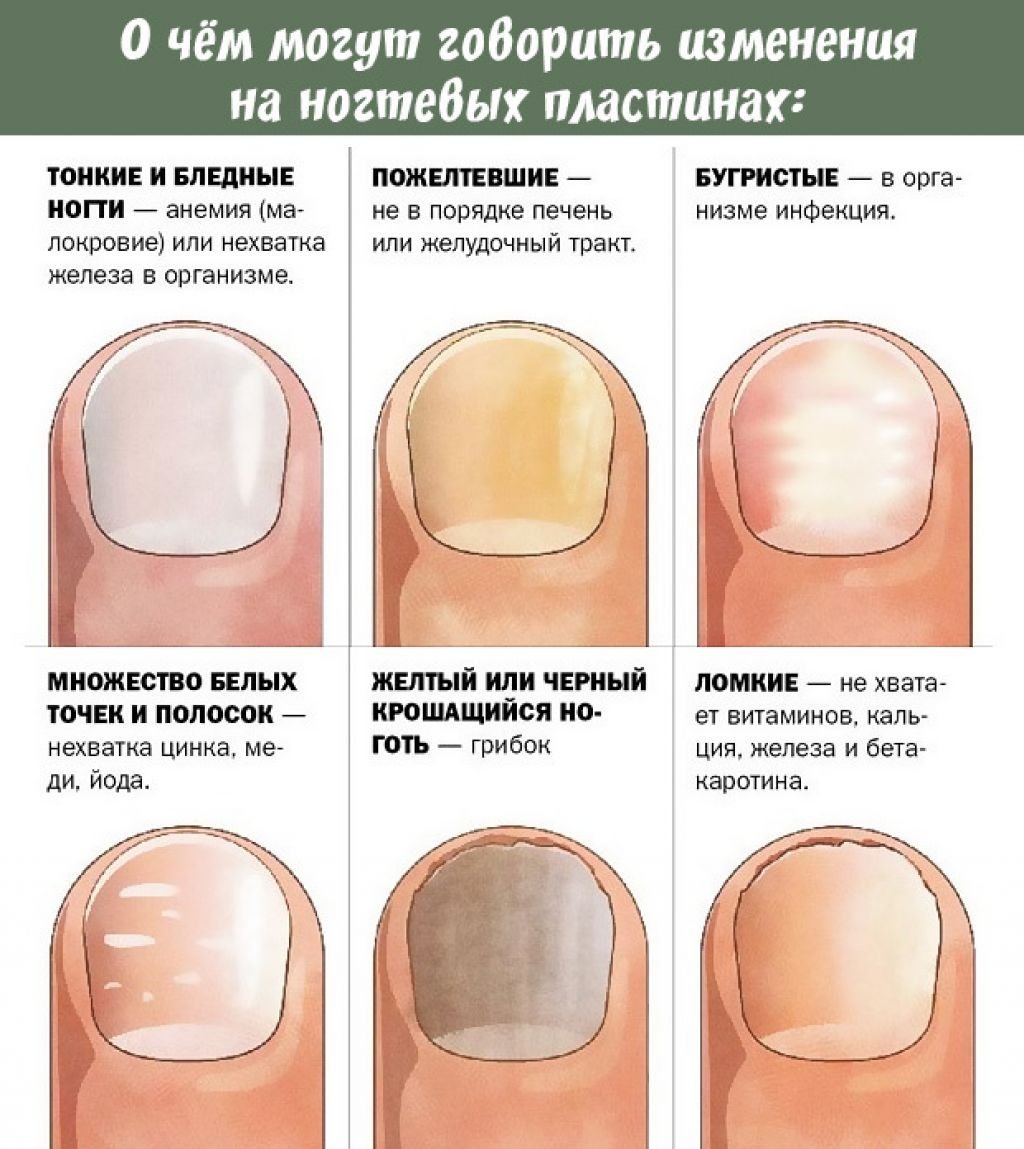 Слоятся ногти у ребенка на руках и ногах