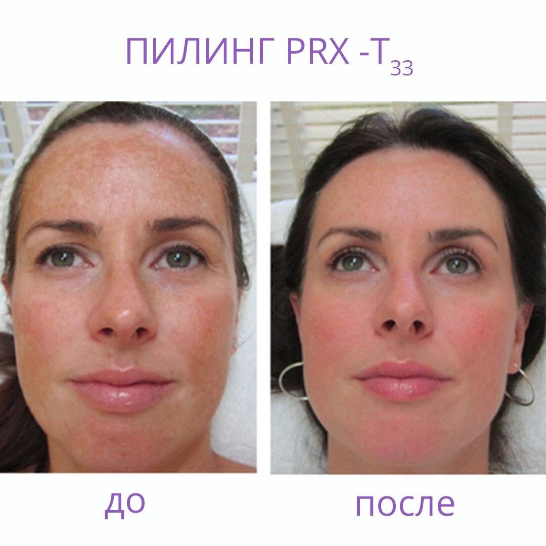 Пилинг гликолевой кислотой в домашних условиях — инструкция для дома